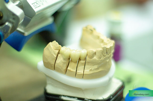 Was Sie über Zahnimplantate wissen sollten